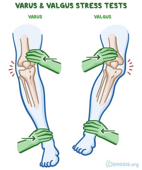 valgus stress test positive